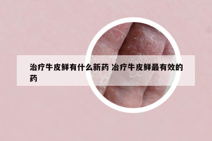 治疗牛皮鲜有什么新药 冶疗牛皮鲜最有效的药