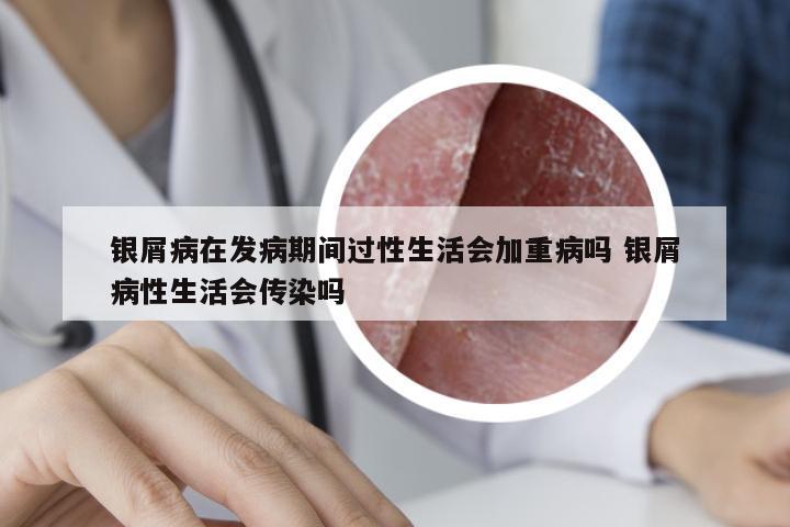 银屑病在发病期间过性生活会加重病吗 银屑病性生活会传染吗