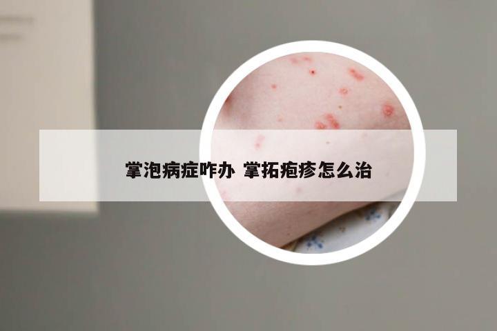 掌泡病症咋办 掌拓疱疹怎么治