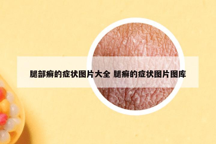 腿部癣的症状图片大全 腿癣的症状图片图库