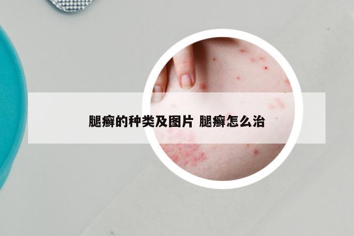 腿癣的种类及图片 腿癣怎么治