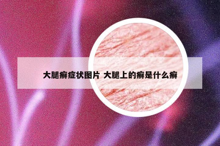 大腿癣症状图片 大腿上的癣是什么癣