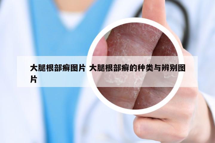 大腿根部癣图片 大腿根部癣的种类与辨别图片