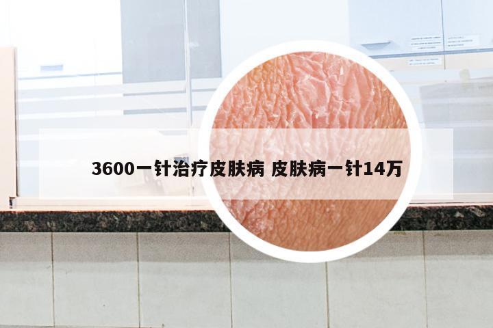 3600一针治疗皮肤病 皮肤病一针14万