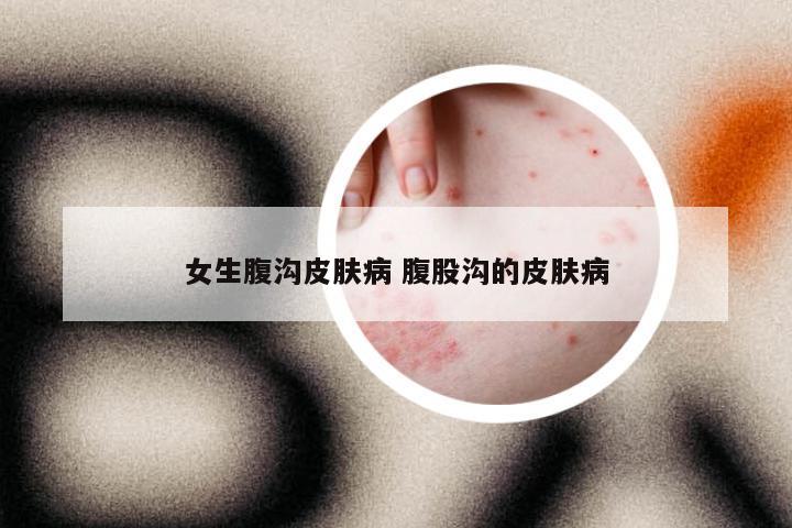 女生腹沟皮肤病 腹股沟的皮肤病