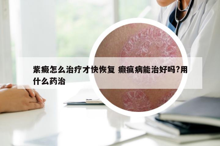 紫癜怎么治疗才快恢复 癫疯病能治好吗?用什么药治