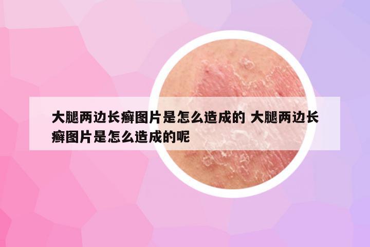 大腿两边长癣图片是怎么造成的 大腿两边长癣图片是怎么造成的呢