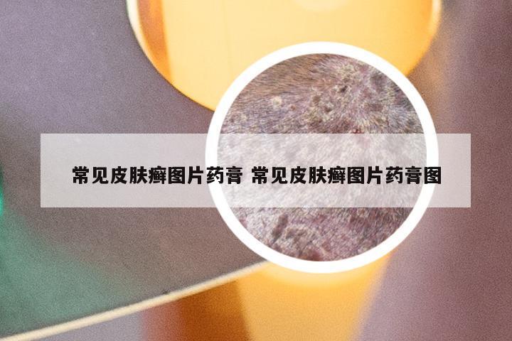 常见皮肤癣图片药膏 常见皮肤癣图片药膏图