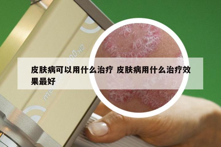 皮肤病可以用什么治疗 皮肤病用什么治疗效果最好