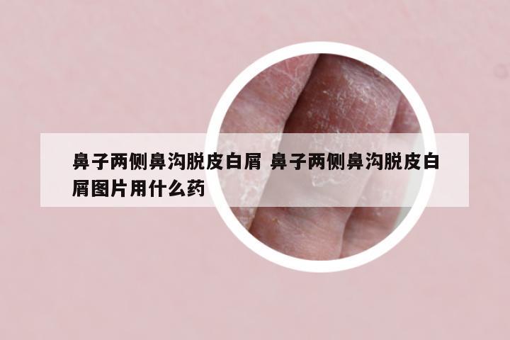 鼻子两侧鼻沟脱皮白屑 鼻子两侧鼻沟脱皮白屑图片用什么药