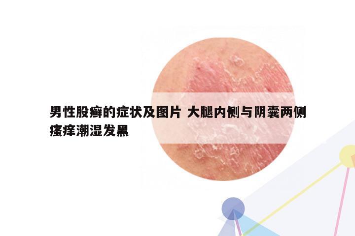 男性股癣的症状及图片 大腿内侧与阴囊两侧瘙痒潮湿发黑