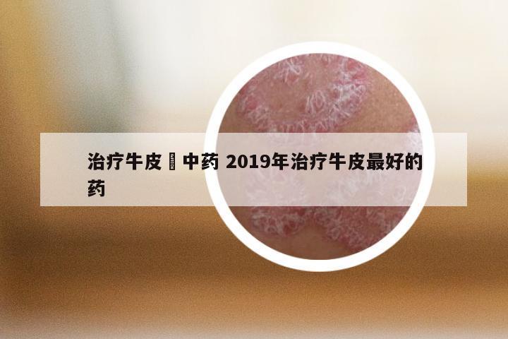 治疗牛皮廯中药 2019年治疗牛皮最好的药