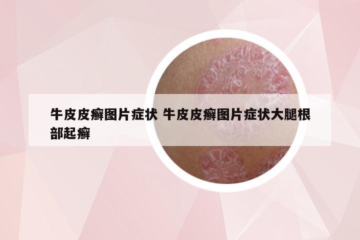 牛皮皮癣图片症状 牛皮皮癣图片症状大腿根部起癣