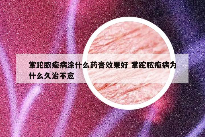 掌跎脓疱病涂什么药膏效果好 掌跎脓疱病为什么久治不愈