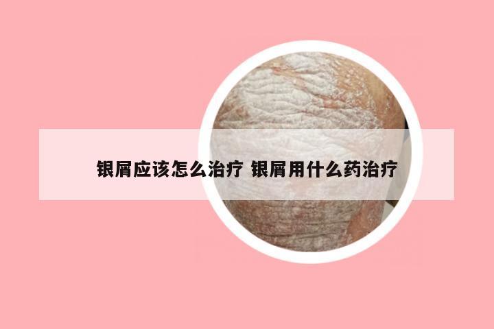 银屑应该怎么治疗 银屑用什么药治疗