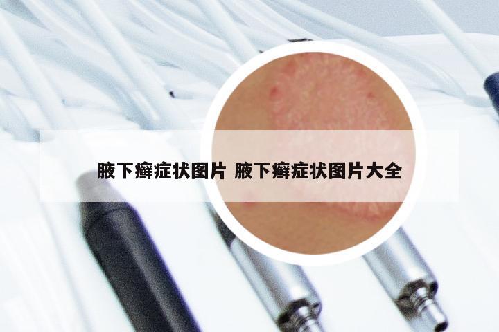 腋下癣症状图片 腋下癣症状图片大全