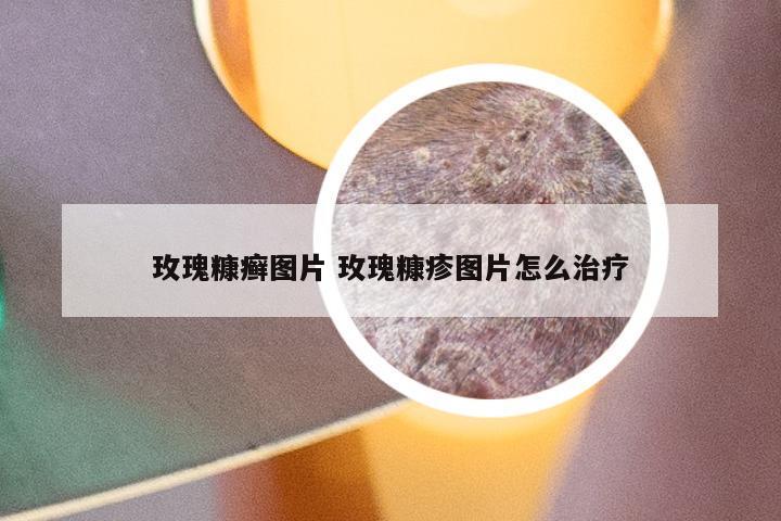 玫瑰糠癣图片 玫瑰糠疹图片怎么治疗