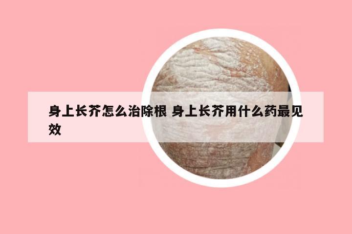 身上长芥怎么治除根 身上长芥用什么药最见效