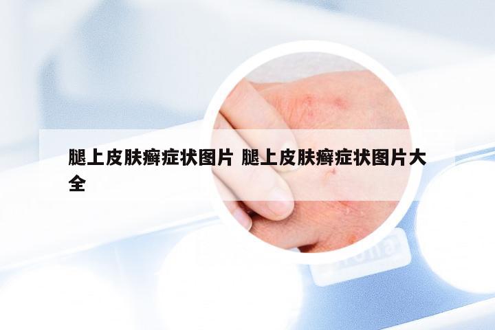 腿上皮肤癣症状图片 腿上皮肤癣症状图片大全