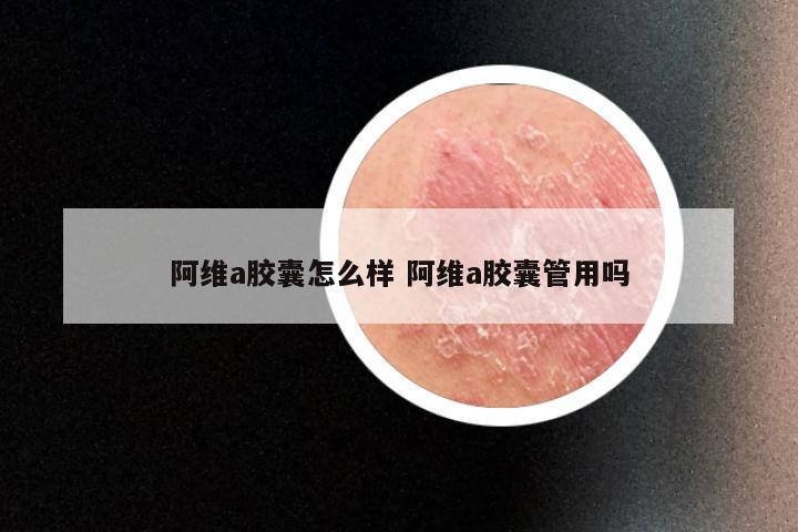 阿维a胶囊怎么样 阿维a胶囊管用吗