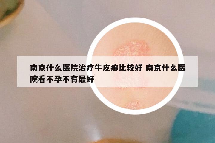 南京什么医院治疗牛皮癣比较好 南京什么医院看不孕不育最好