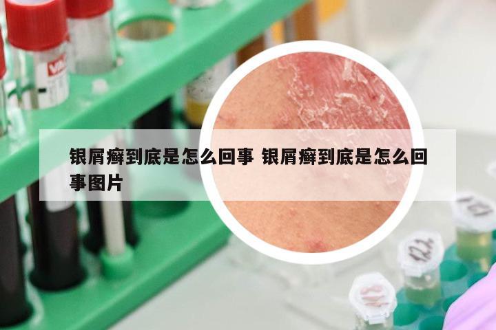 银屑癣到底是怎么回事 银屑癣到底是怎么回事图片