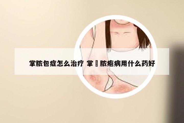 掌脓包症怎么治疗 掌踀脓疱病用什么药好