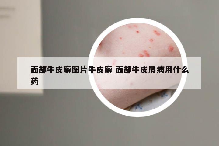 面部牛皮廨图片牛皮廨 面部牛皮屑病用什么药