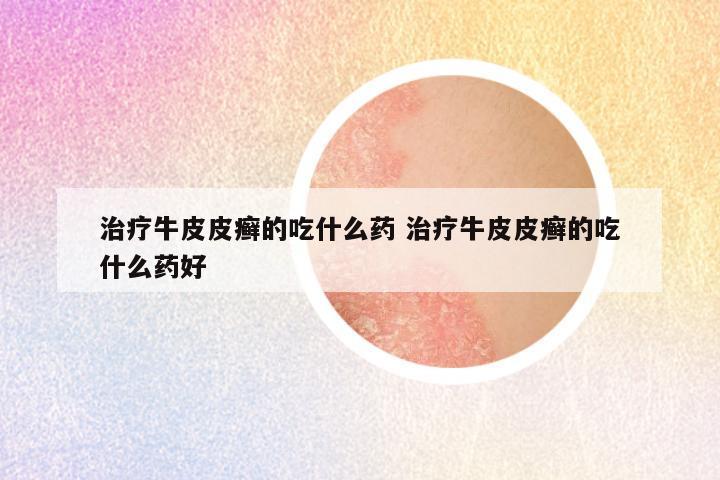 治疗牛皮皮癣的吃什么药 治疗牛皮皮癣的吃什么药好