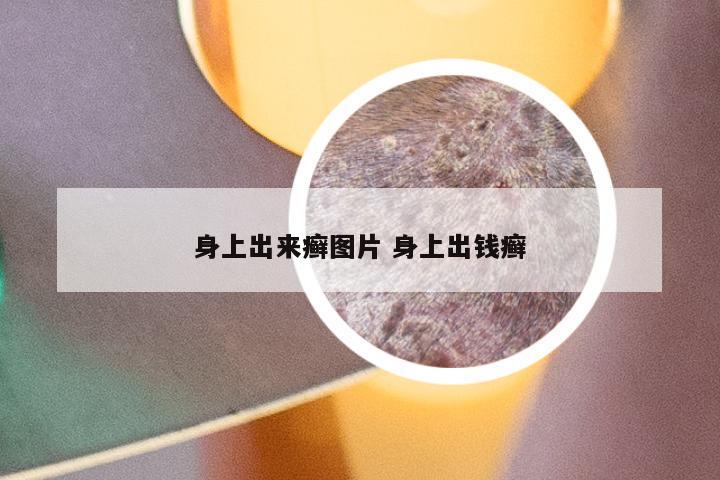 身上出来癣图片 身上出钱癣