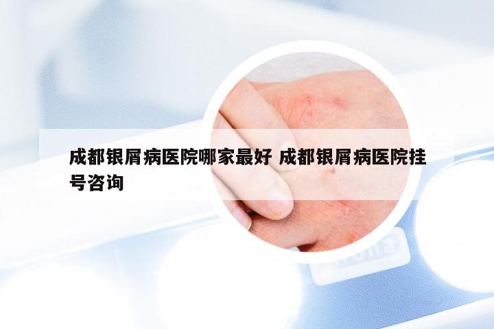 成都银屑病医院哪家最好 成都银屑病医院挂号咨询