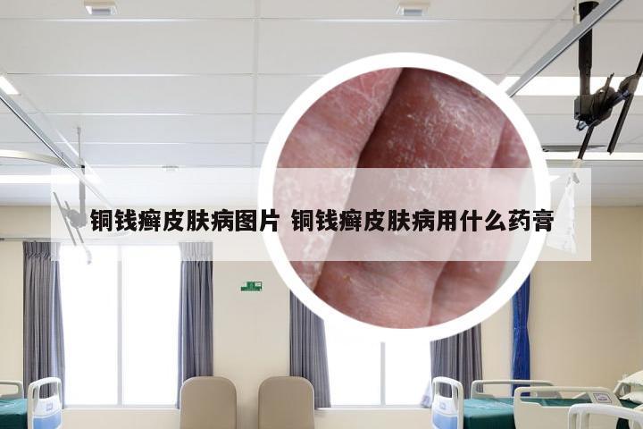 铜钱癣皮肤病图片 铜钱癣皮肤病用什么药膏