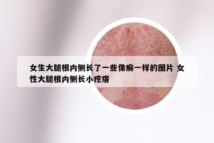 女生大腿根内侧长了一些像癣一样的图片 女性大腿根内侧长小疙瘩