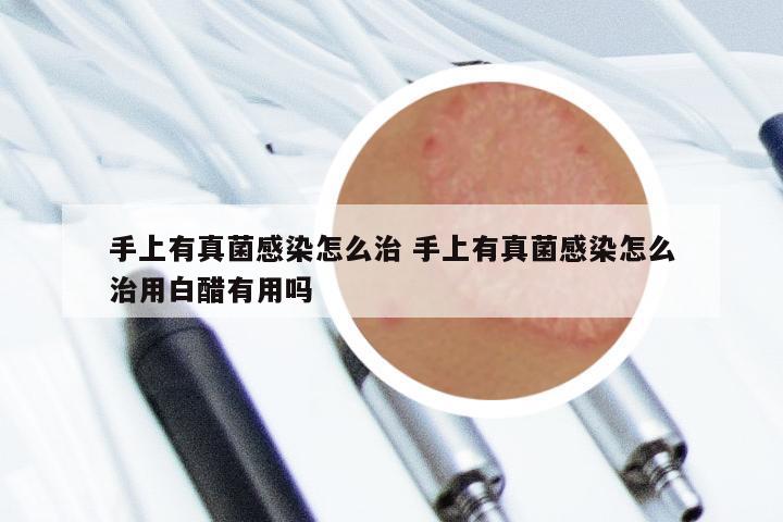 手上有真菌感染怎么治 手上有真菌感染怎么治用白醋有用吗