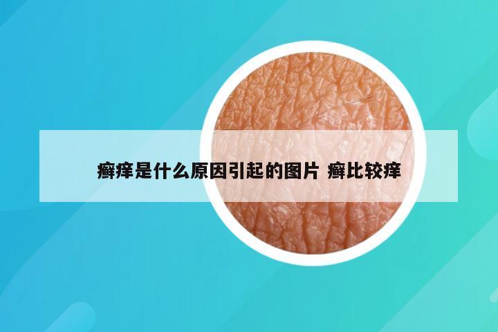 癣痒是什么原因引起的图片 癣比较痒