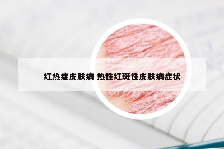 红热症皮肤病 热性红斑性皮肤病症状