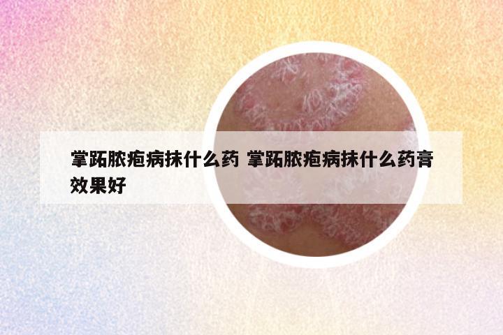 掌跖脓疱病抹什么药 掌跖脓疱病抹什么药膏效果好