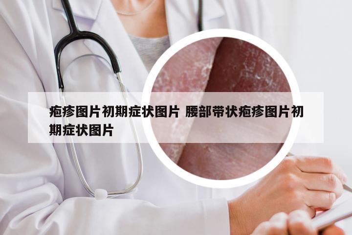 疱疹图片初期症状图片 腰部带状疱疹图片初期症状图片