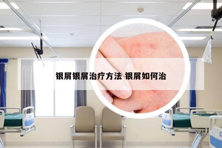 银屑银屑治疗方法 银屑如何治