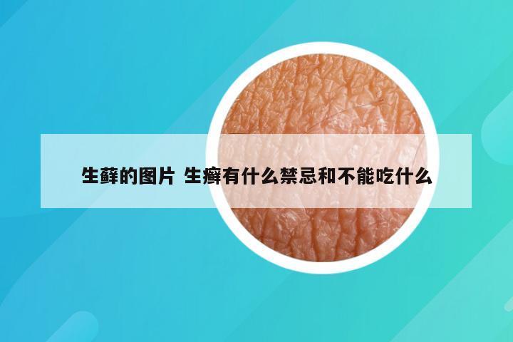 生藓的图片 生癣有什么禁忌和不能吃什么