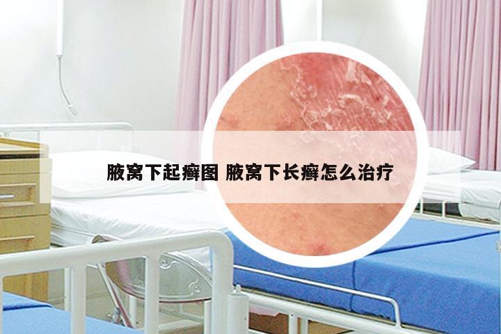 腋窝下起癣图 腋窝下长癣怎么治疗