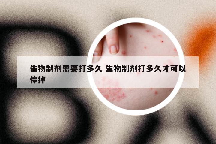 生物制剂需要打多久 生物制剂打多久才可以停掉