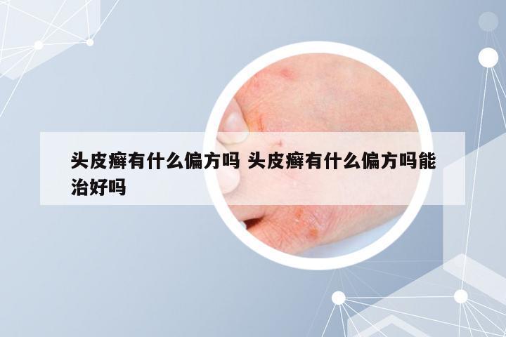 头皮癣有什么偏方吗 头皮癣有什么偏方吗能治好吗