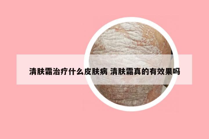 清肤霜治疗什么皮肤病 清肤霜真的有效果吗