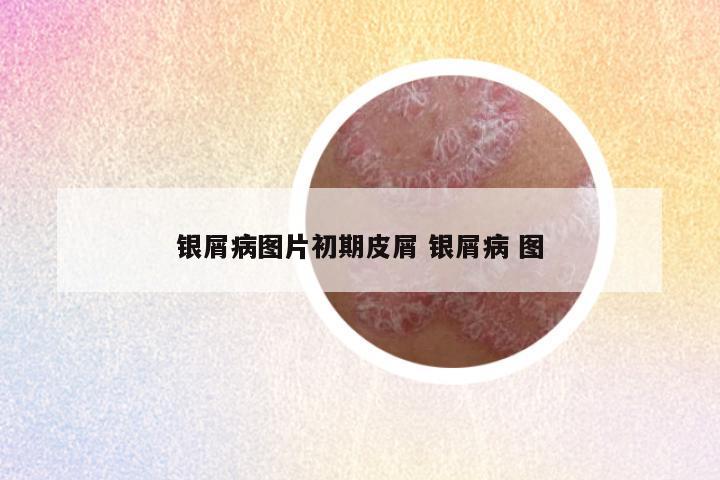 银屑病图片初期皮屑 银屑病 图