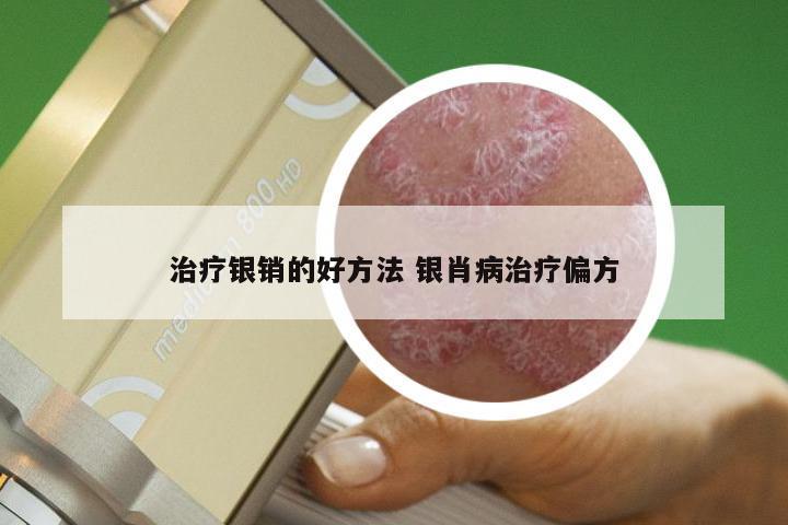 治疗银销的好方法 银肖病治疗偏方