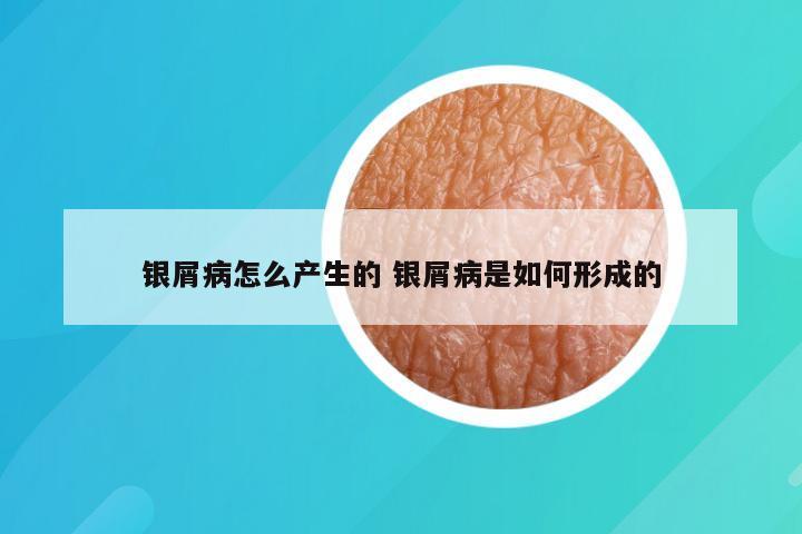 银屑病怎么产生的 银屑病是如何形成的