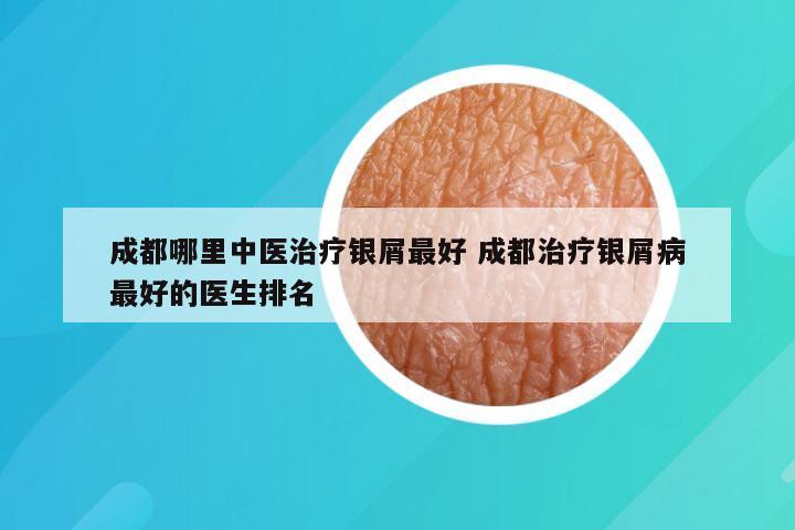 成都哪里中医治疗银屑最好 成都治疗银屑病最好的医生排名