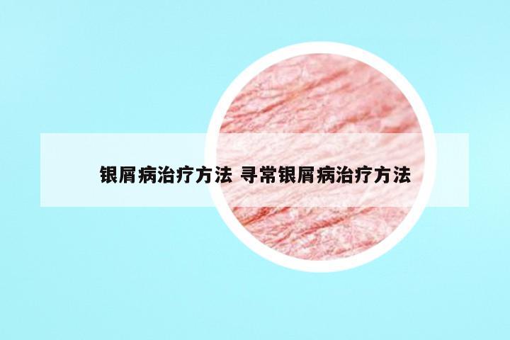 银屑病治疗方法 寻常银屑病治疗方法