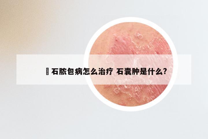 礃石脓包病怎么治疗 石囊肿是什么?